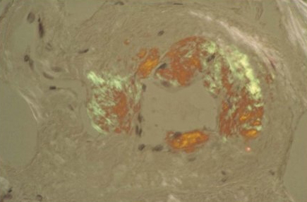 Assessment of proteinuria images