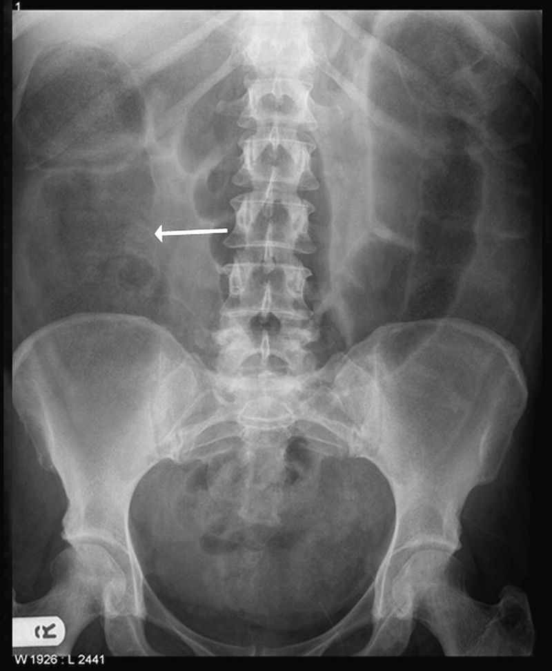 Obstrução do intestino grosso images