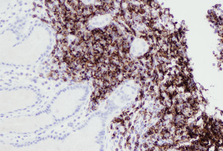MALT lymphoma images