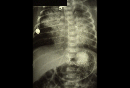 Disorders of infant feeding images