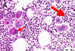 Trombocitemia essencial images