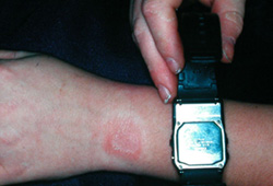Dermatite de contato images