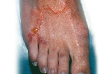 Larva migrans cutânea images
