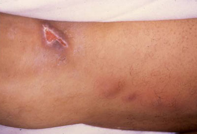 Tularaemia images