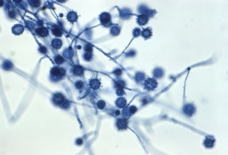Histoplasmosis images