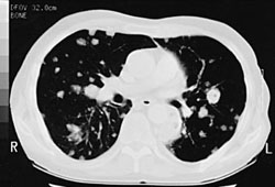 Nocardiosis images