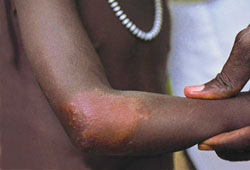 Leprosy images