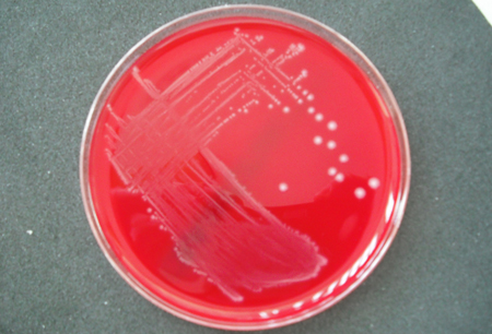 Group B streptococcal infection images