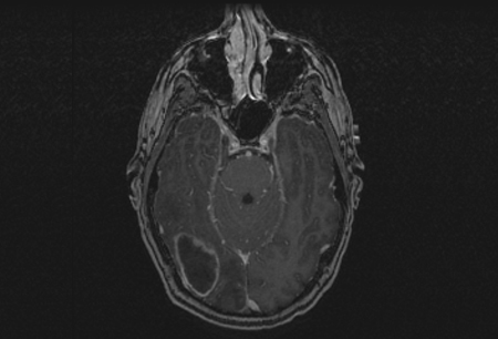 Abscesso cerebral images
