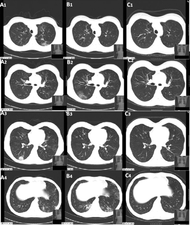 Eosinophilic granulomatosis with polyangiitis (Churg-Strauss syndrome) images