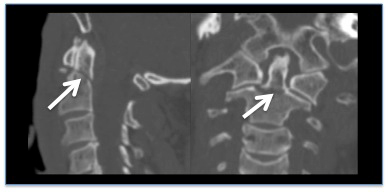 Acute cervical spine trauma images