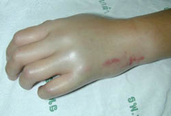 Snake bites images