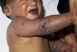 Wiskott-Aldrich syndrome images