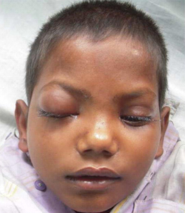 Cavernous sinus thrombosis images