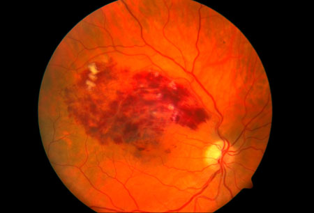 Oclusão da veia retiniana images