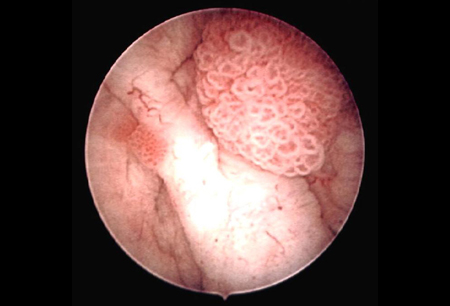 Bladder cancer images
