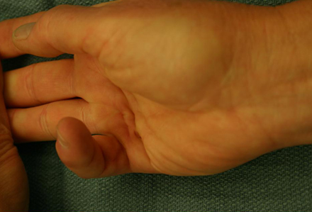 Dupuytren's contracture images