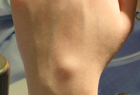 Ganglion cyst images