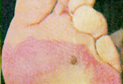 Frostbite images