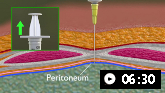 Demostración animada de paracentesis abdominal