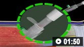 Demostración animada de la canulación venosa periférica