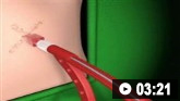 Inserção de dreno intercostal, técnica de Seldinger: vídeo de demonstração