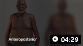 Demonstração animada de uma cardioversão elétrica (por corrente contínua)